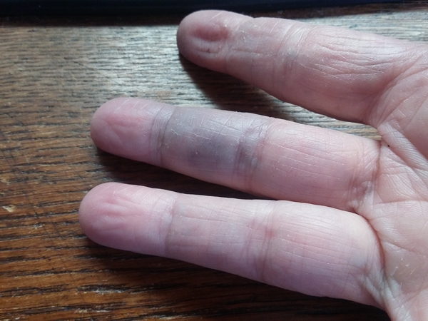 20150331 blauwe vinger